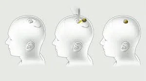 Neuralinks Brain Chip 05 jpg